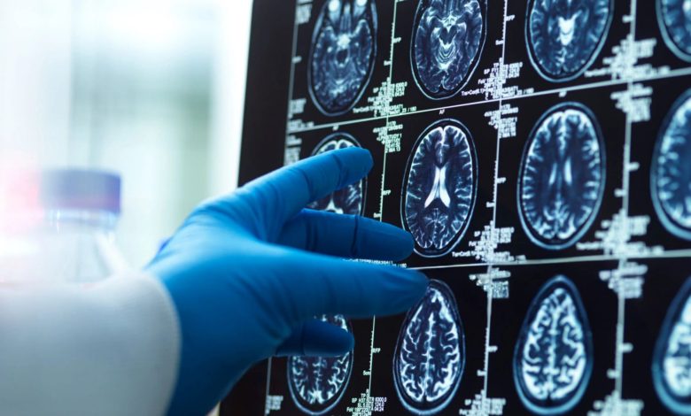 A doctor's hand in a surgical glove pointing at a brain scan image on a computer screen, diagnostic tools and medical concepts.